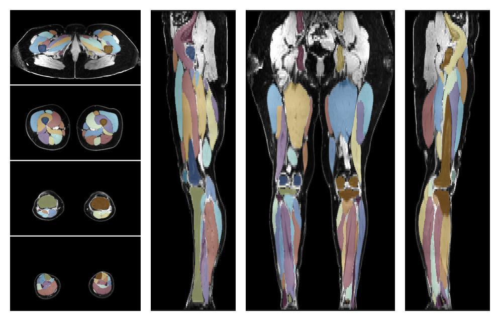 Overlay of automated muscle segmentation labels on dixon water image.