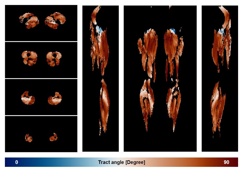 Muscle fiber tract angle map based on whole leg DTI based fiber tractography.