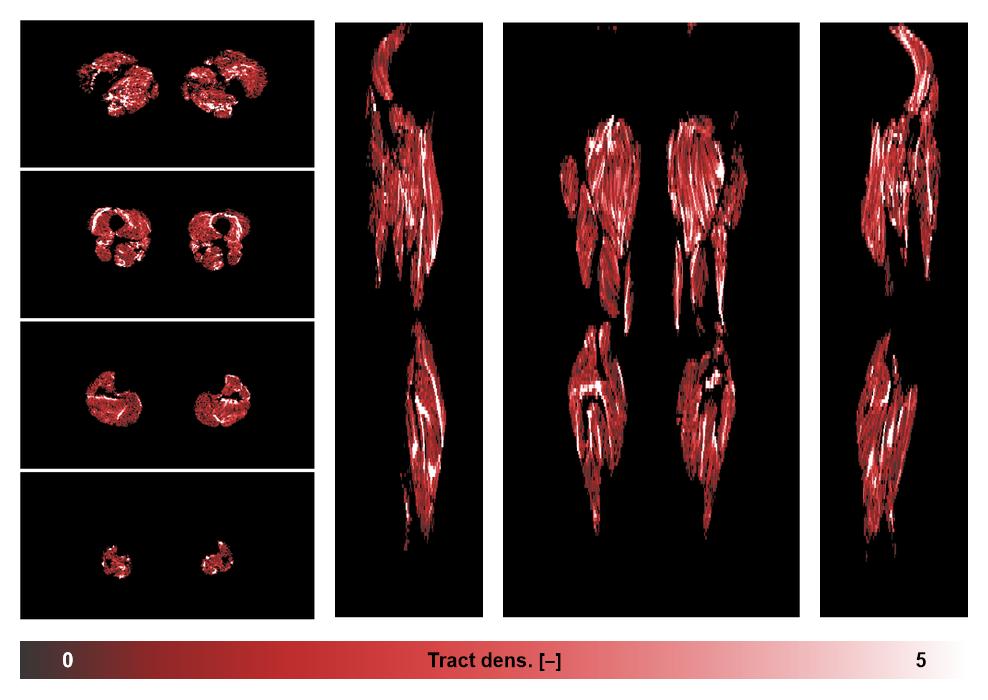 Muscle fiber tract density map based on whole leg DTI based fiber tractography.