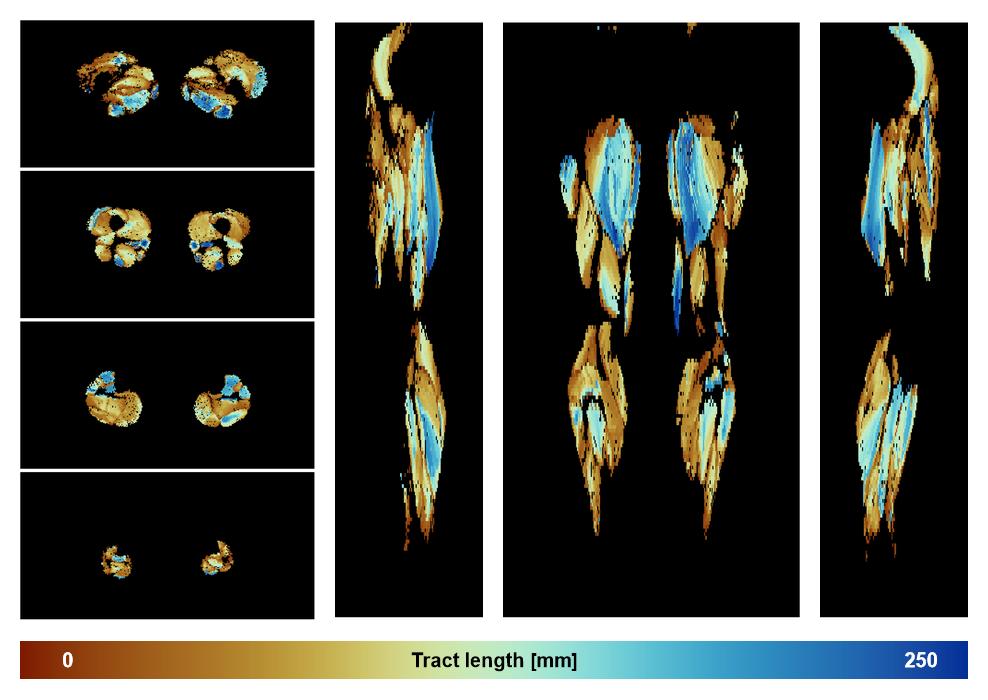 Muscle fiber tract length map based on whole leg DTI based fiber tractography.