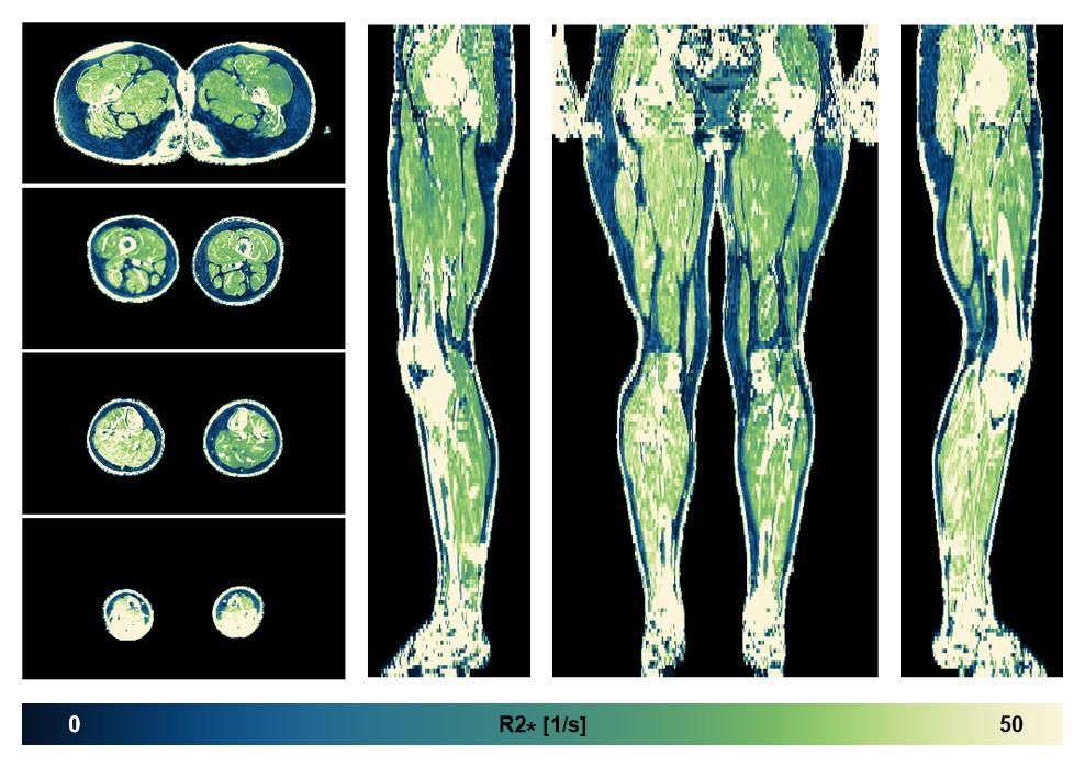 The R2 star relaxation time of the lower extremity obtained from the dixon reconstruction for muscle water fat quantification.