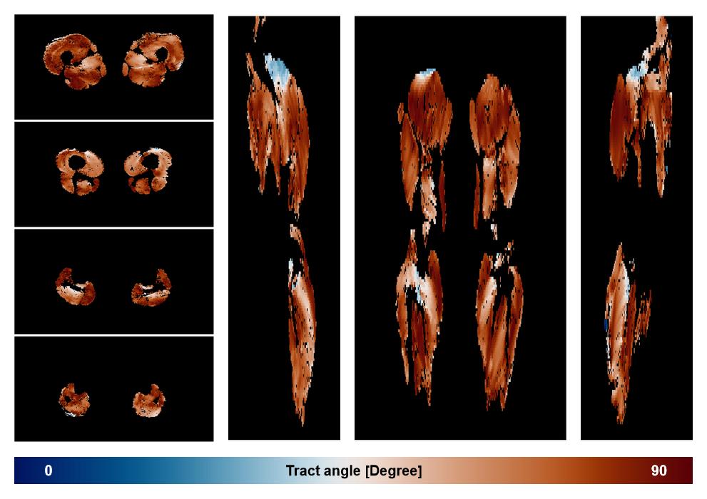 Muscle fiber tract angle map based on whole leg DTI based fiber tractography.