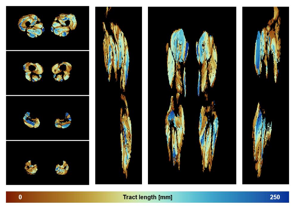 Muscle fiber tract length map based on whole leg DTI based fiber tractography.
