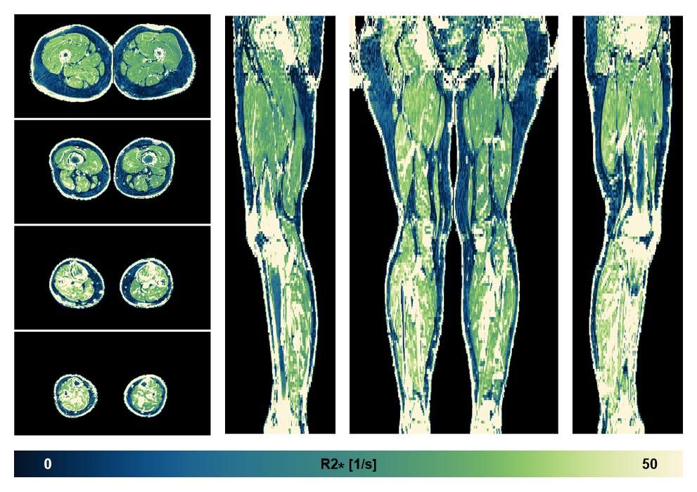 The R2 star relaxation time of the lower extremity obtained from the dixon reconstruction for muscle water fat quantification.