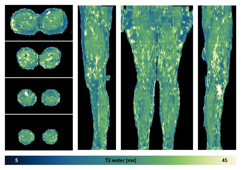 The water only T2 relaxation time of the lower extremity obtained from multi echo spin echo t2 mapping with EPG based reconstruction.