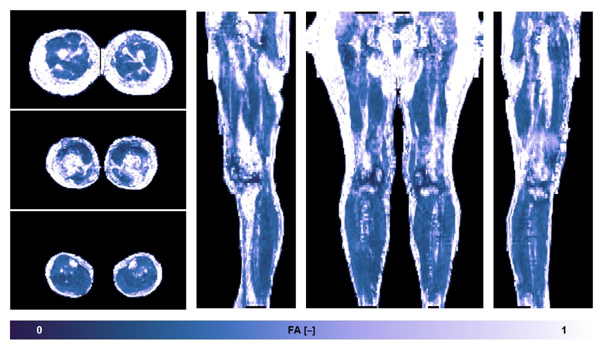 IVIM corrected whole leg muscle fractional anisotropy obtained from diffusion tensor imaging.