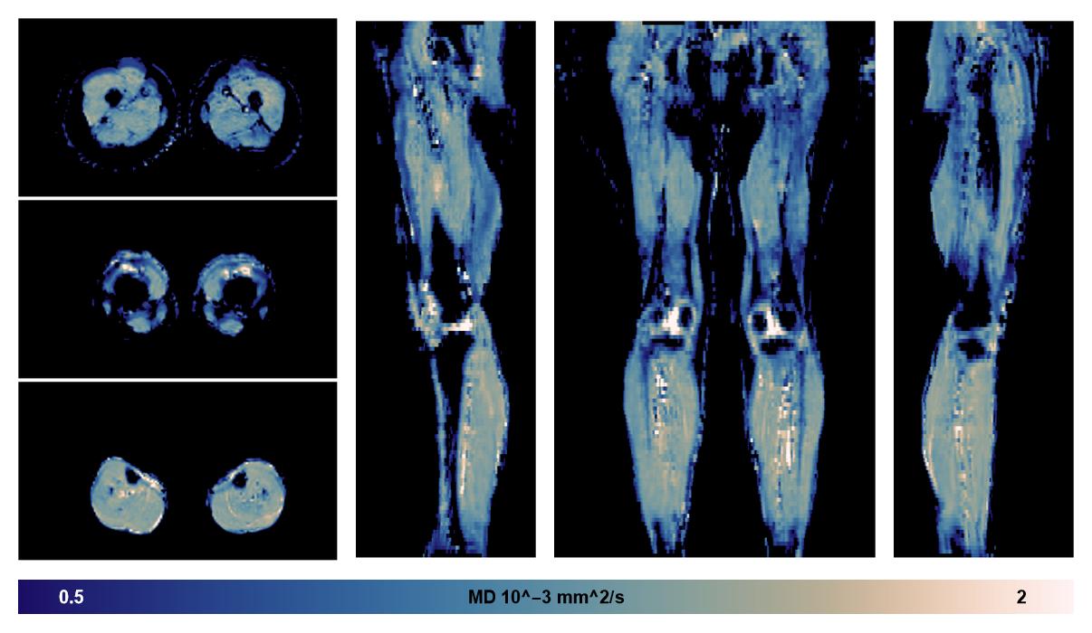 IVIM corrected whole leg muscle mean diffusivity obtained from diffusion tensor imaging.