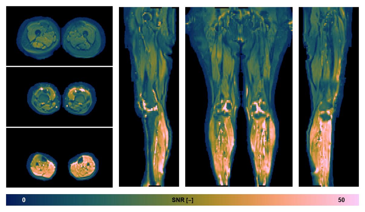 SNR distribution of the unweighted diffusion data.