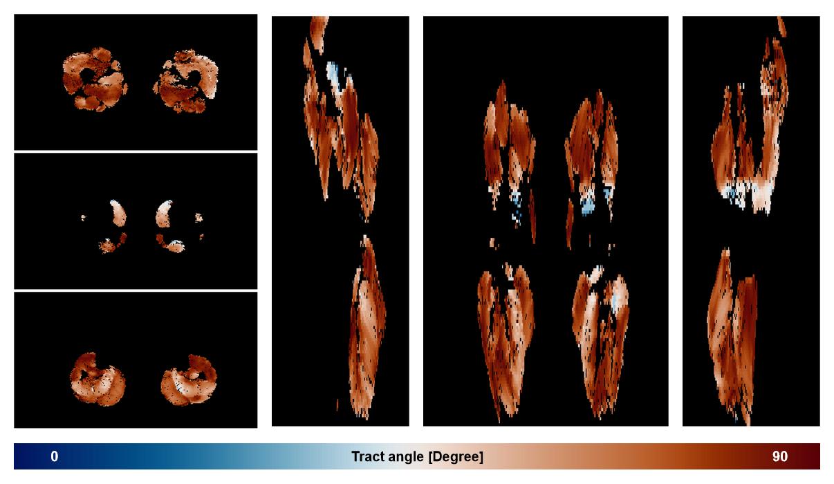 Muscle fiber tract angle map based on whole leg DTI based fiber tractography.