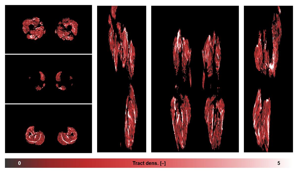Muscle fiber tract density map based on whole leg DTI based fiber tractography.