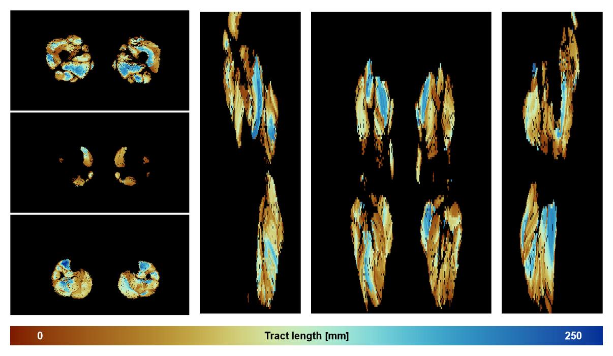 Muscle fiber tract length map based on whole leg DTI based fiber tractography.