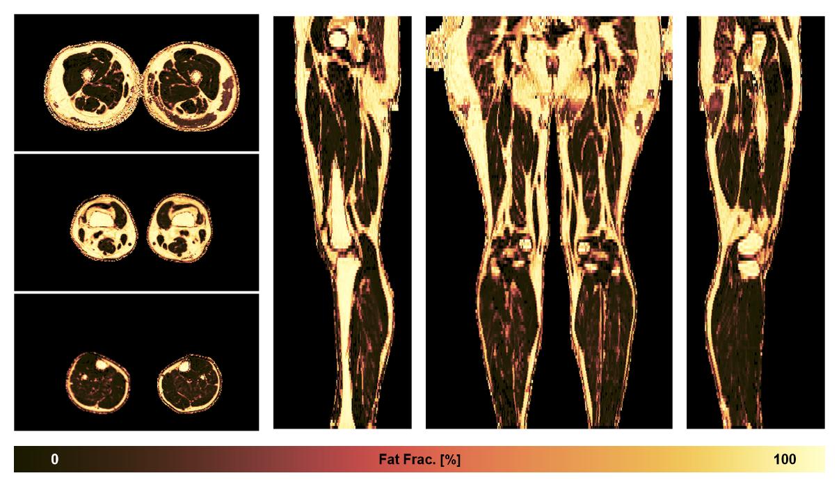 The fat fraction of the lower extremity obtained from the dixon reconstruction for muscle water fat quantification.