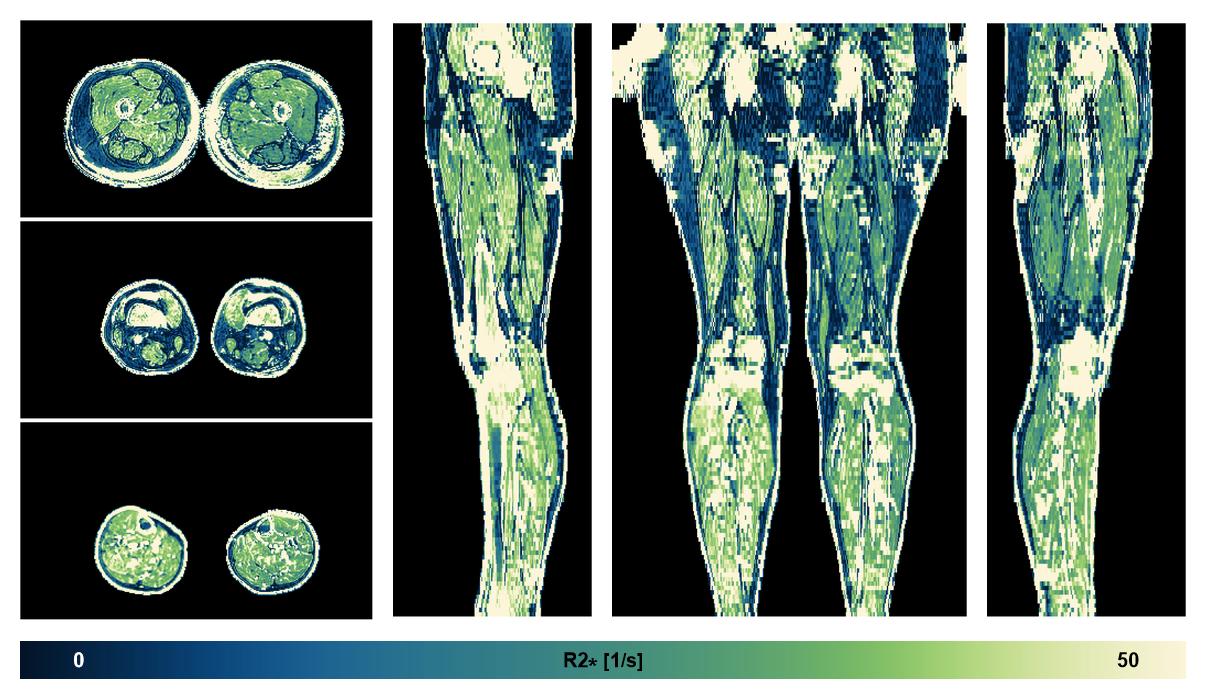 The R2 star relaxation time of the lower extremity obtained from the dixon reconstruction for muscle water fat quantification.