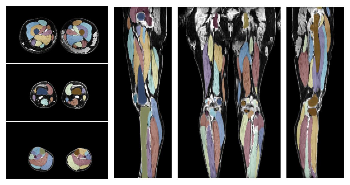 Overlay of automated muscle segmentation labels on dixon water image.