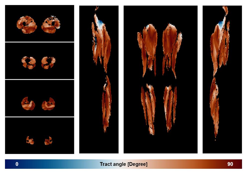 Muscle fiber tract angle map based on whole leg DTI based fiber tractography.