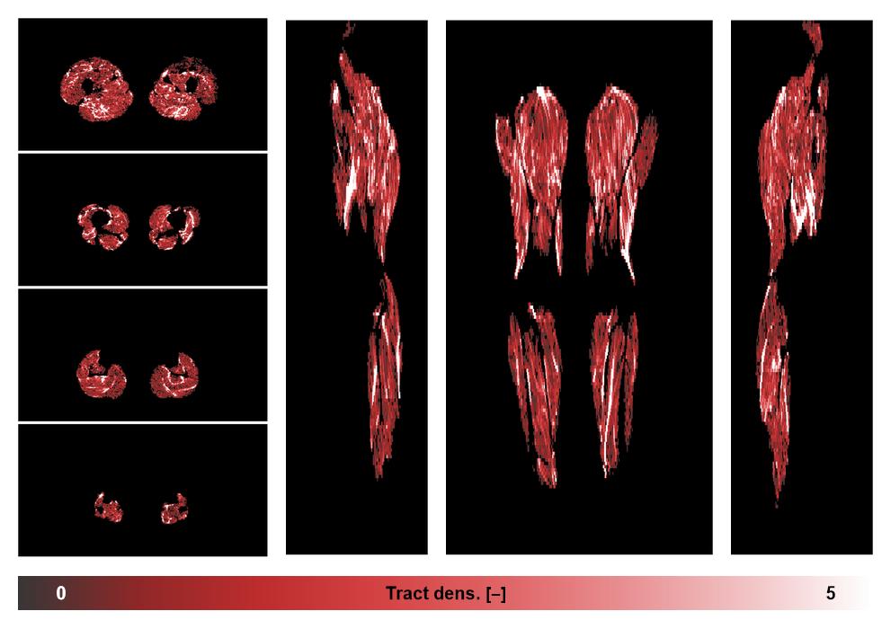 Muscle fiber tract density map based on whole leg DTI based fiber tractography.