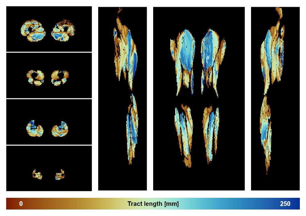 Muscle fiber tract length map based on whole leg DTI based fiber tractography.