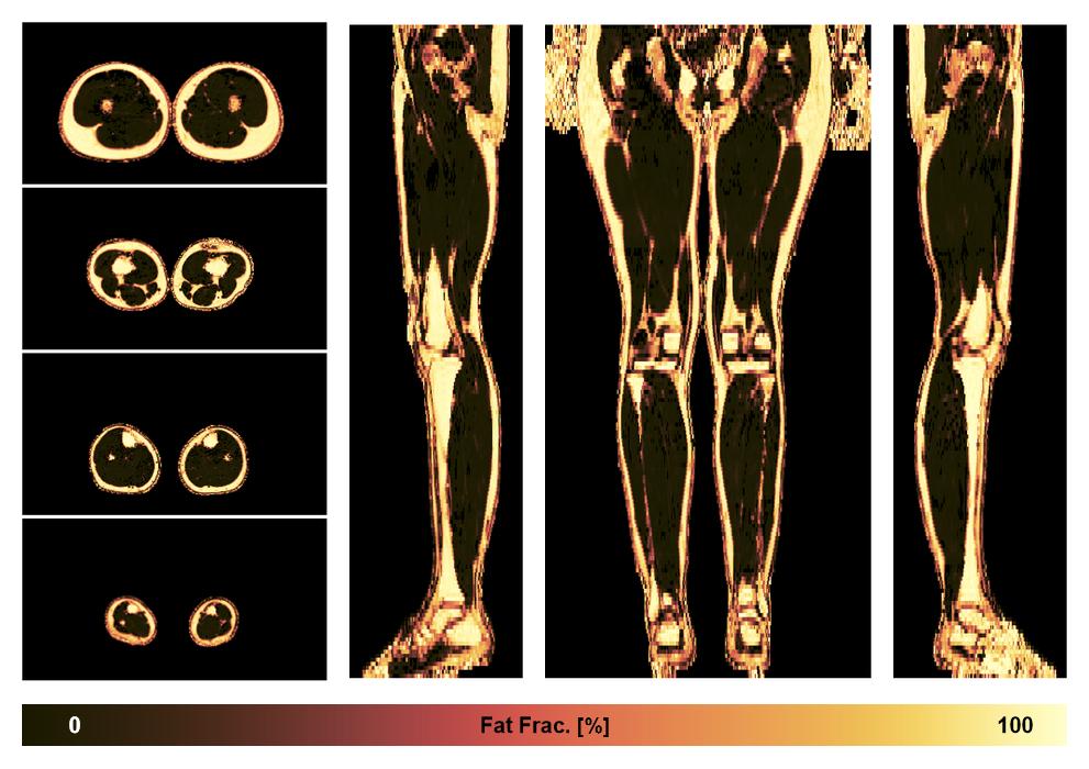 The fat fraction of the lower extremity obtained from the dixon reconstruction for muscle water fat quantification.