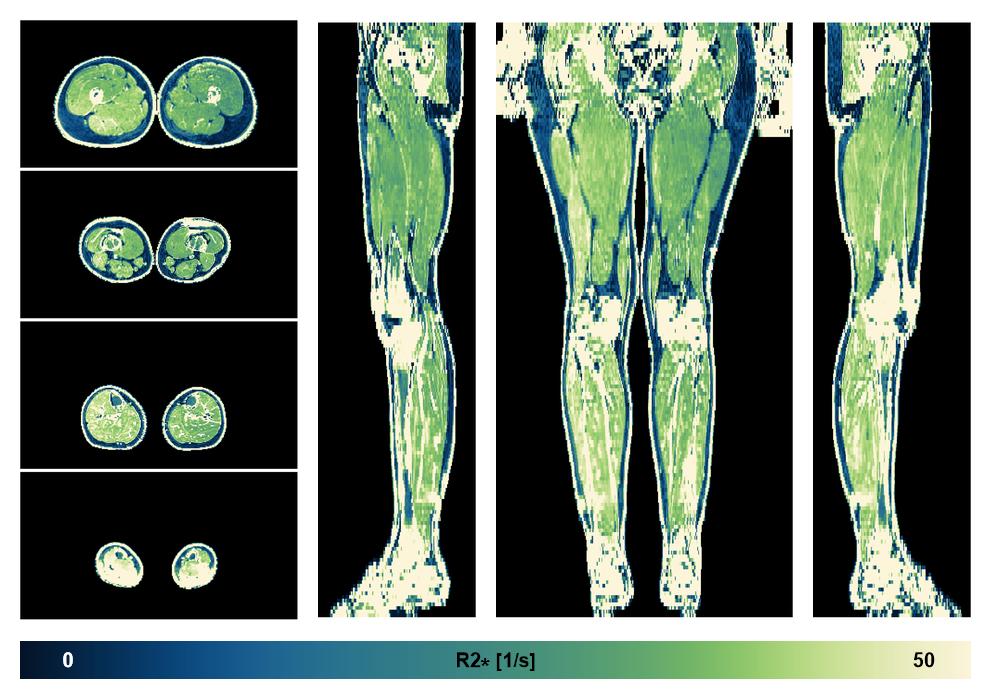 The R2 star relaxation time of the lower extremity obtained from the dixon reconstruction for muscle water fat quantification.