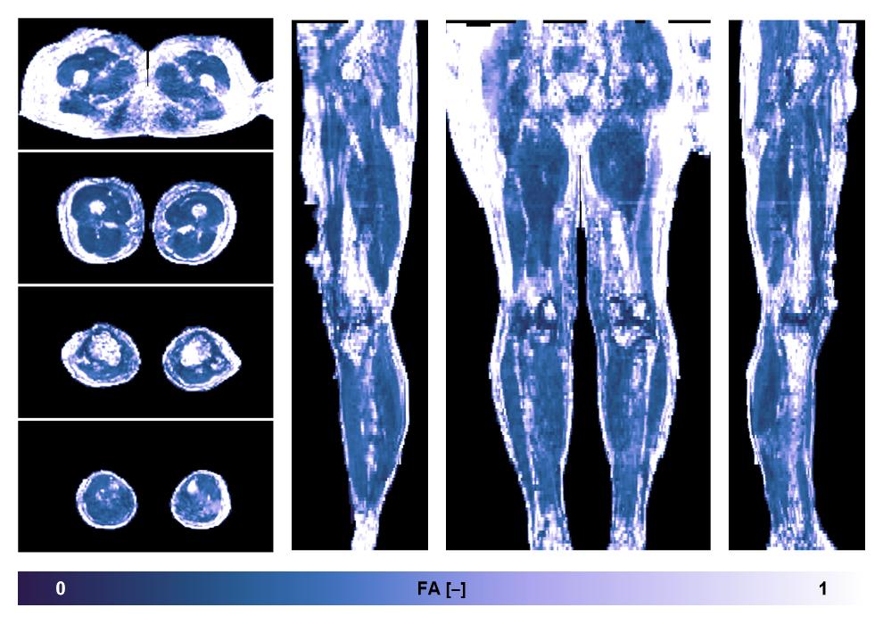 IVIM corrected whole leg muscle fractional anisotropy obtained from diffusion tensor imaging.