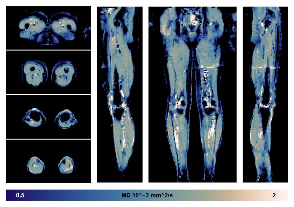 IVIM corrected whole leg muscle mean diffusivity obtained from diffusion tensor imaging.