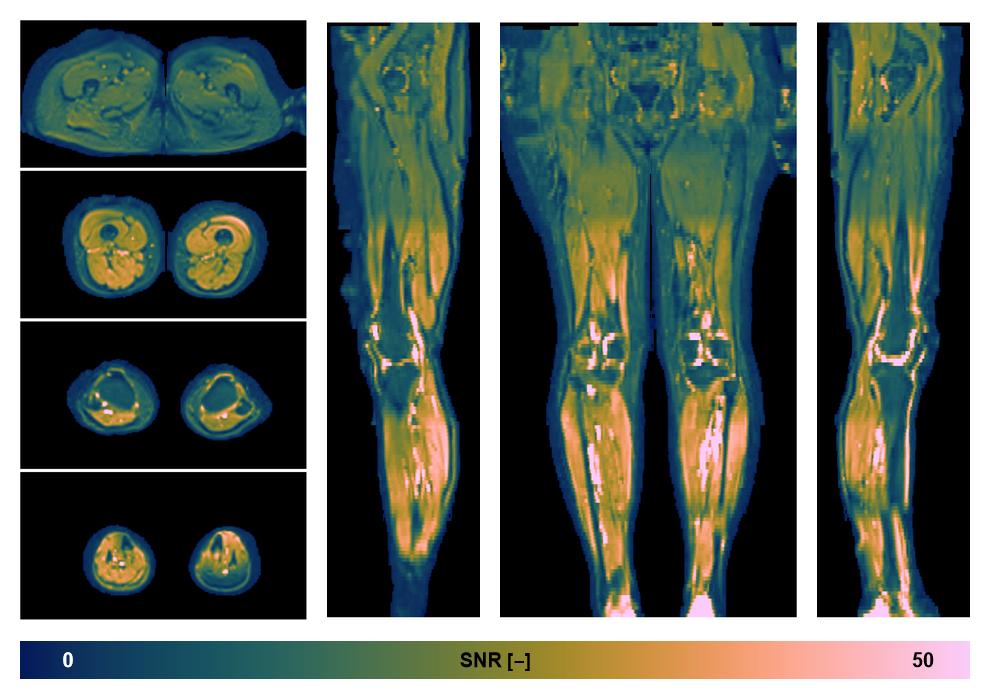 SNR distribution of the unweighted diffusion data.