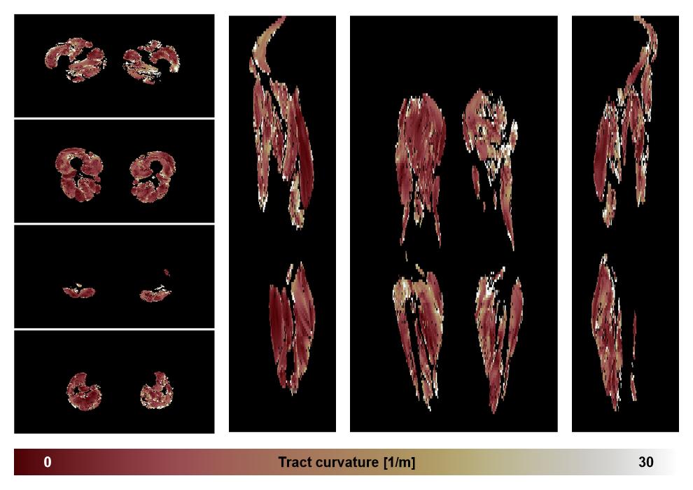 Muscle fiber tract curvature map based on whole leg DTI based fiber tractography.