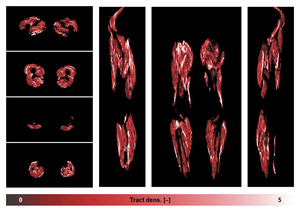 Muscle fiber tract density map based on whole leg DTI based fiber tractography.