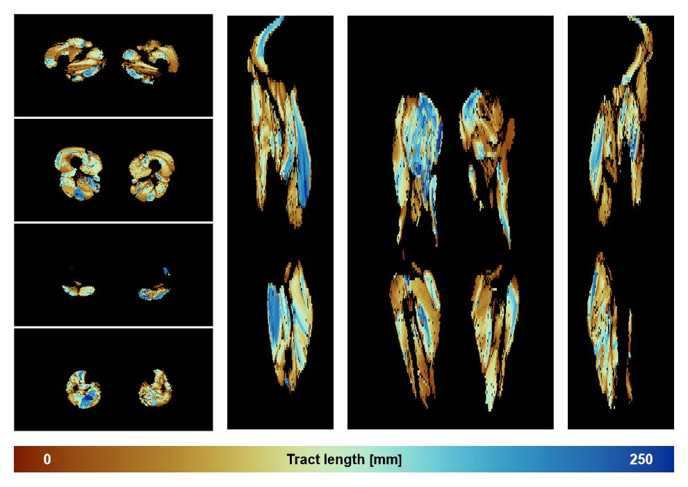 Muscle fiber tract length map based on whole leg DTI based fiber tractography.