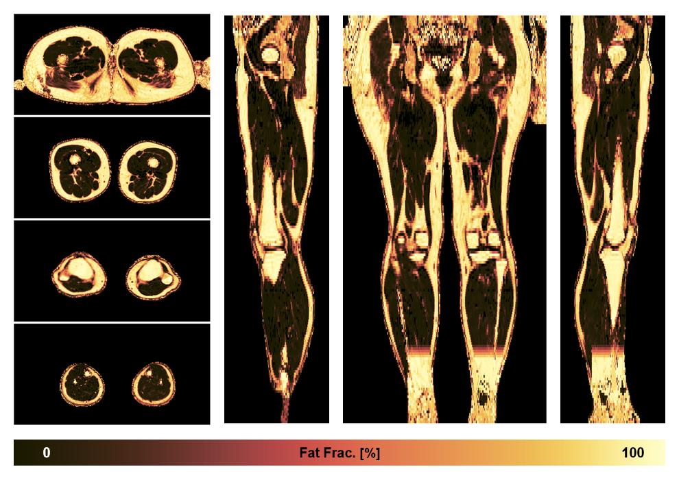 The fat fraction of the lower extremity obtained from the dixon reconstruction for muscle water fat quantification.