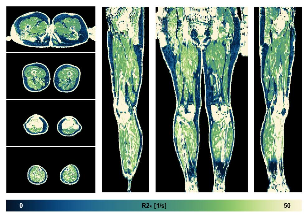 The R2 star relaxation time of the lower extremity obtained from the dixon reconstruction for muscle water fat quantification.