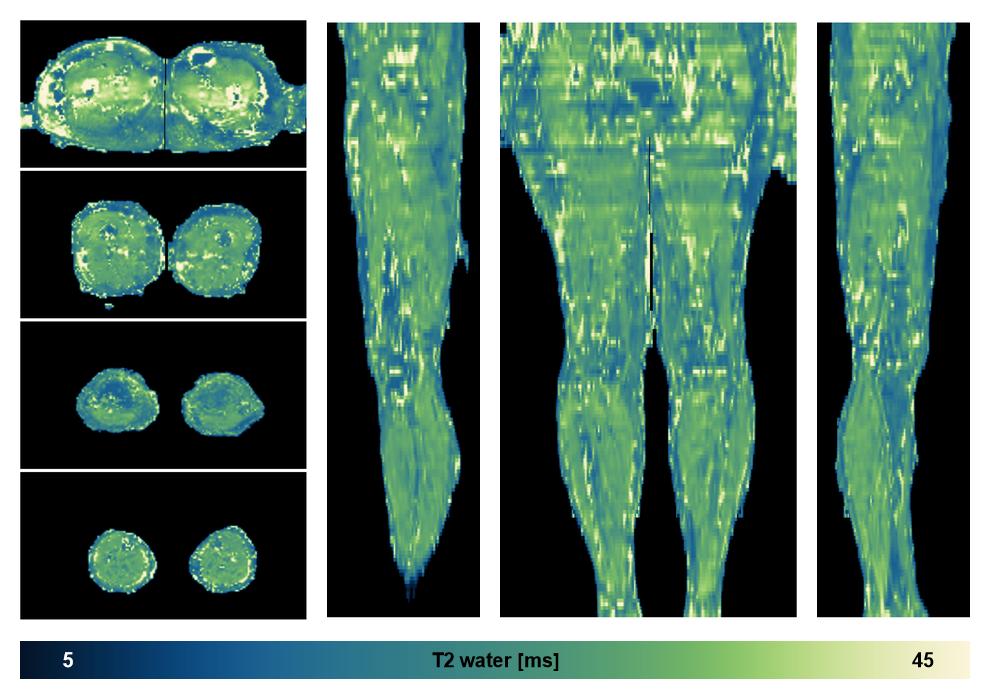 The water only T2 relaxation time of the lower extremity obtained from multi echo spin echo t2 mapping with EPG based reconstruction.