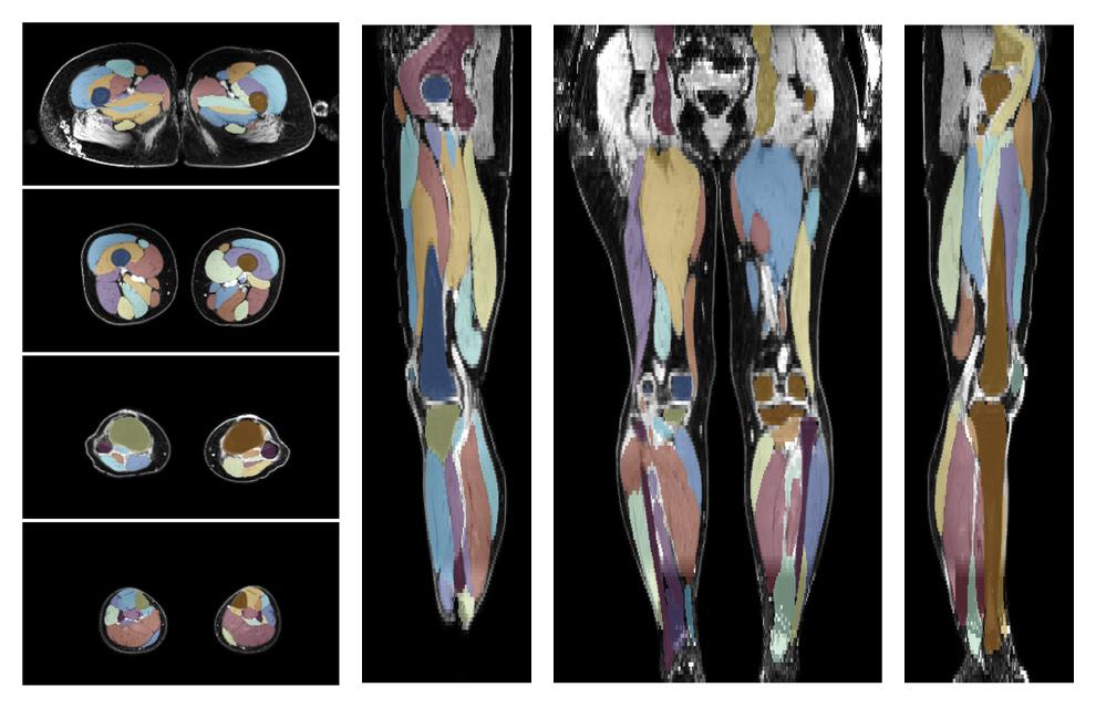 Overlay of automated muscle segmentation labels on dixon water image.