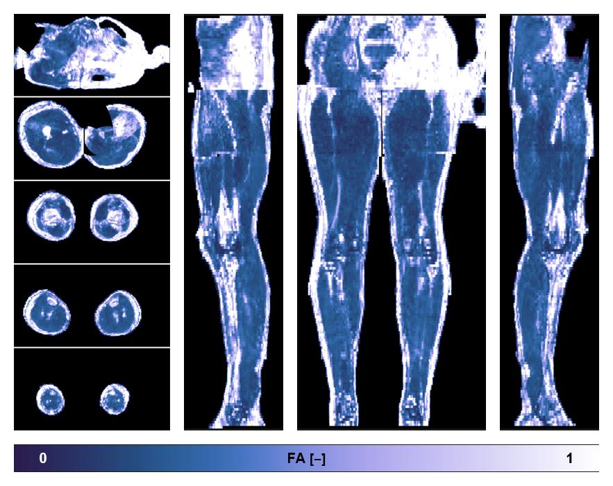 IVIM corrected whole leg muscle fractional anisotropy obtained from diffusion tensor imaging.