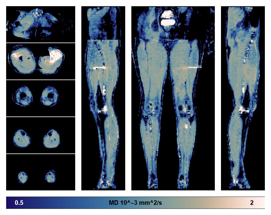 IVIM corrected whole leg muscle mean diffusivity obtained from diffusion tensor imaging.