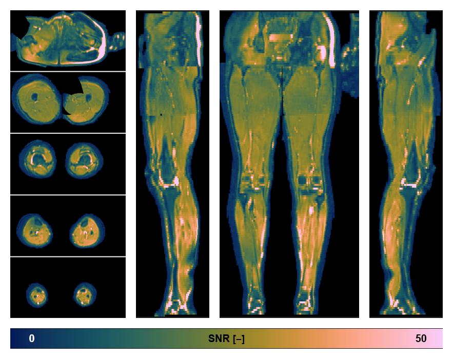 SNR distribution of the unweighted diffusion data.