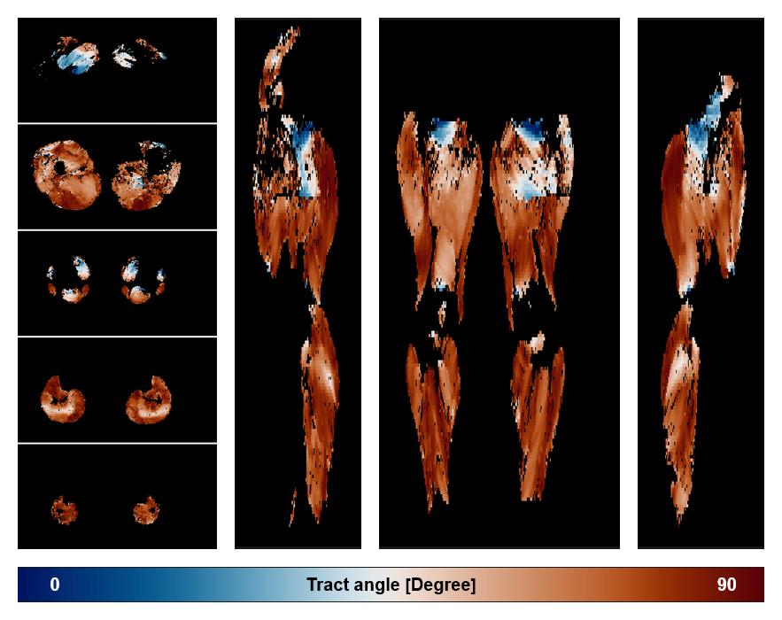 Muscle fiber tract angle map based on whole leg DTI based fiber tractography.