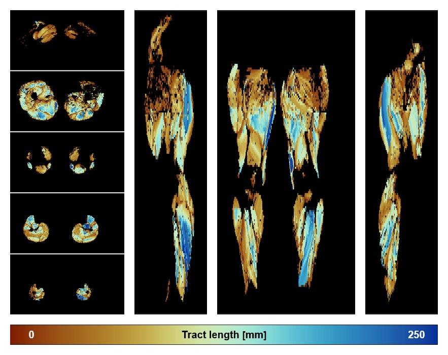 Muscle fiber tract length map based on whole leg DTI based fiber tractography.