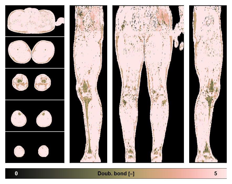Number of double bonds in subcutanious fat.