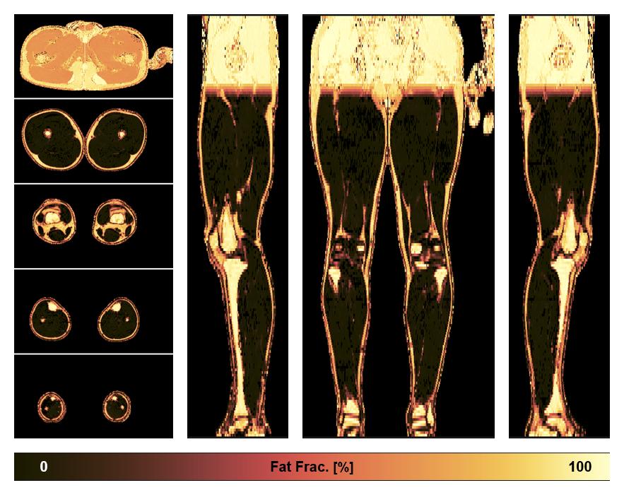 The fat fraction of the lower extremity obtained from the dixon reconstruction for muscle water fat quantification.