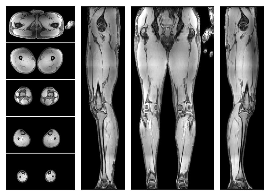 The out-phase image of the dixon reconstruction for water fat quantification.