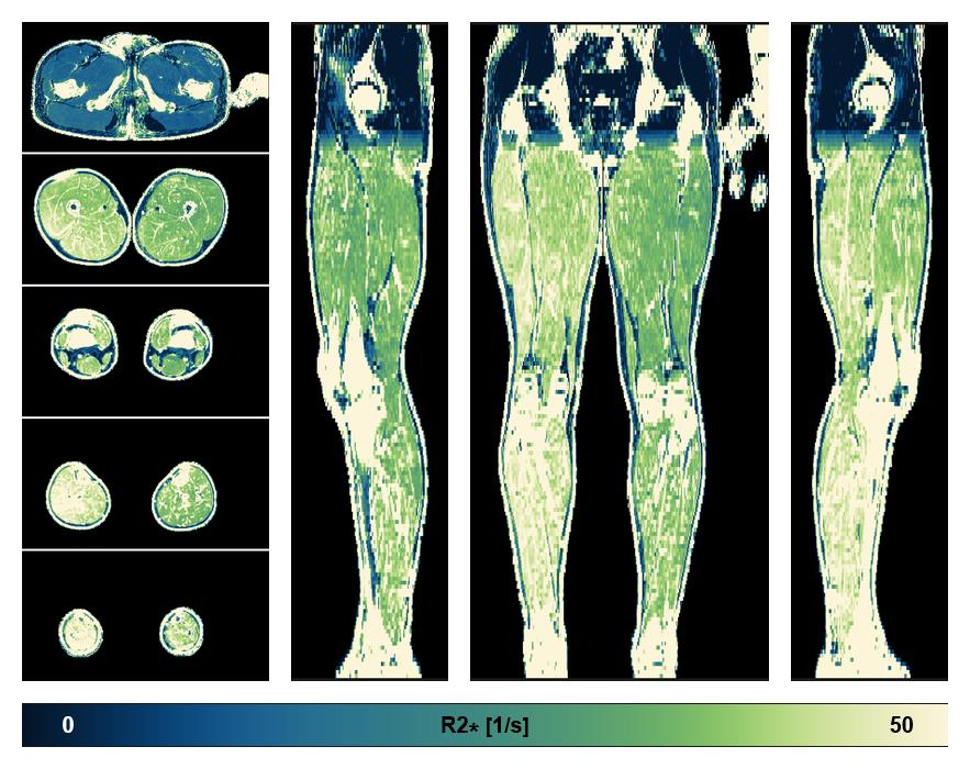 The R2 star relaxation time of the lower extremity obtained from the dixon reconstruction for muscle water fat quantification.
