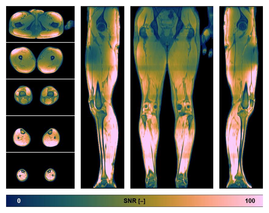 The SNR distribution of the dixon data.