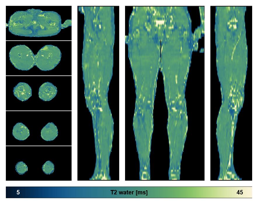 The water only T2 relaxation time of the lower extremity obtained from multi echo spin echo t2 mapping with EPG based reconstruction.