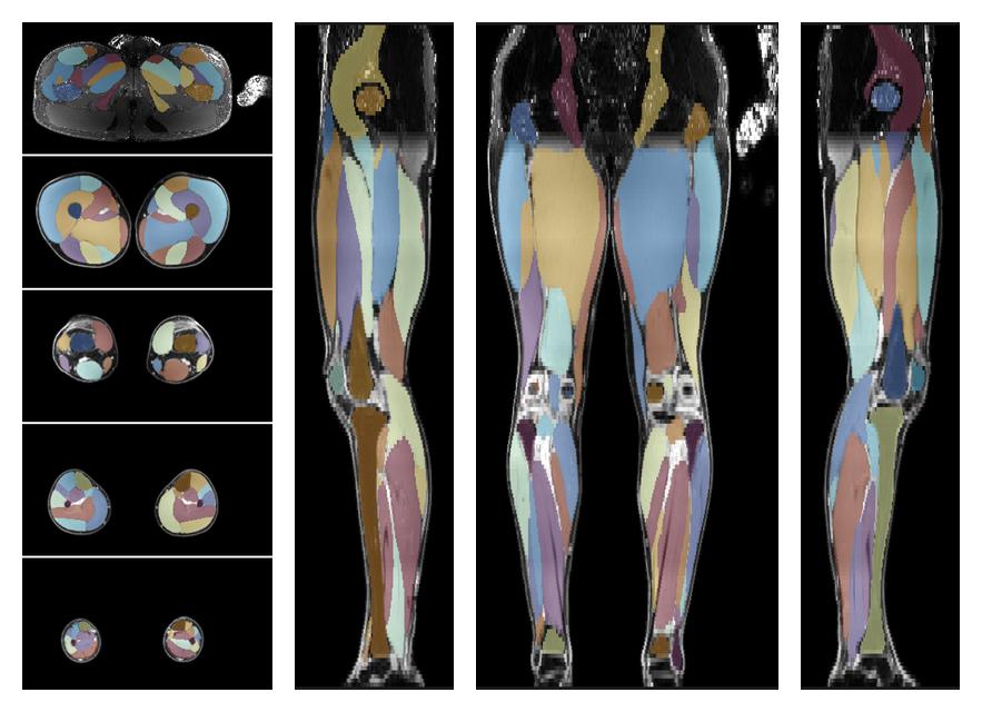 Overlay of automated muscle segmentation labels on dixon water image.