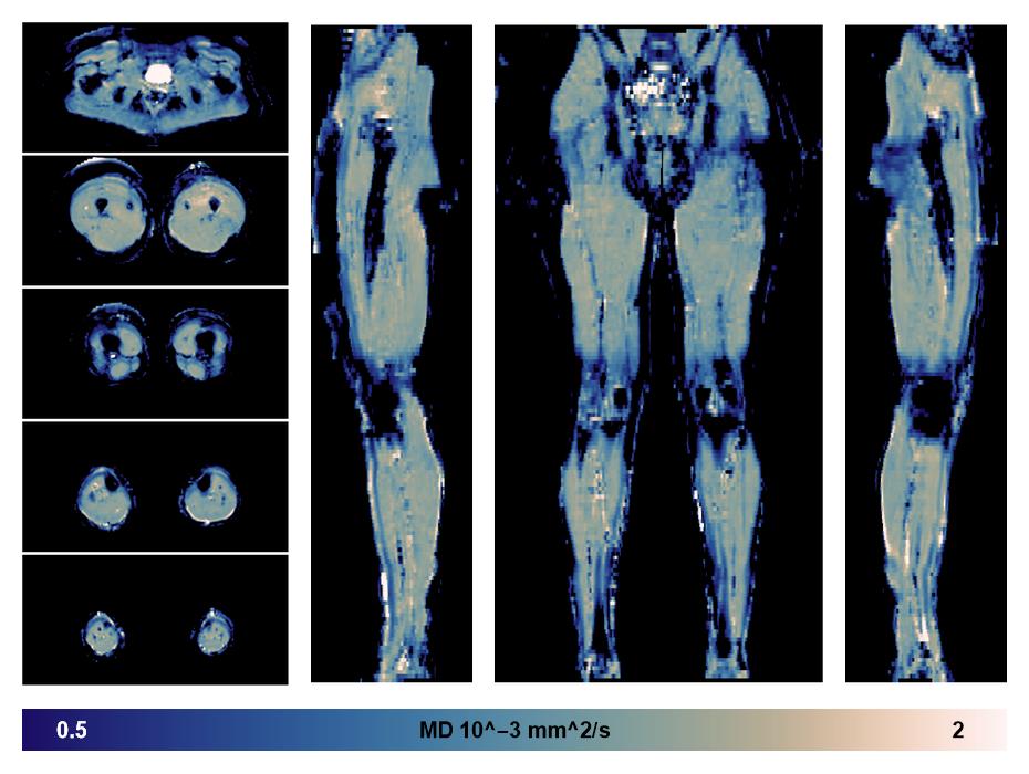 IVIM corrected whole leg muscle mean diffusivity obtained from diffusion tensor imaging.