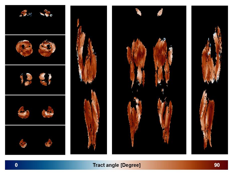 Muscle fiber tract angle map based on whole leg DTI based fiber tractography.