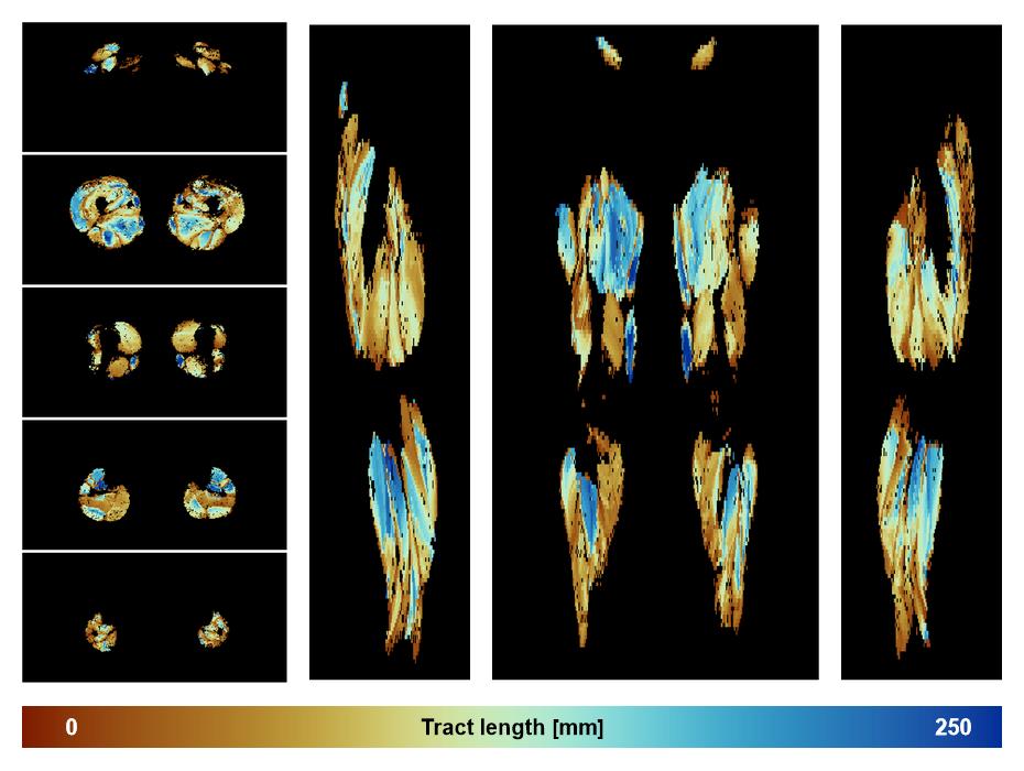 Muscle fiber tract length map based on whole leg DTI based fiber tractography.