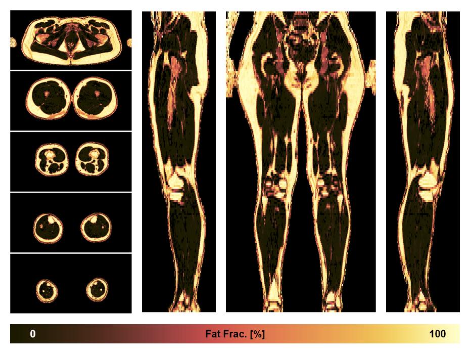 The fat fraction of the lower extremity obtained from the dixon reconstruction for muscle water fat quantification.