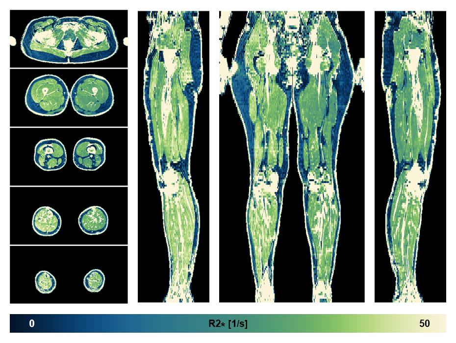 The R2 star relaxation time of the lower extremity obtained from the dixon reconstruction for muscle water fat quantification.